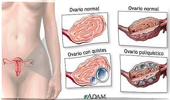 5 Facts About Ovarian Cysts Every Woman Should Know