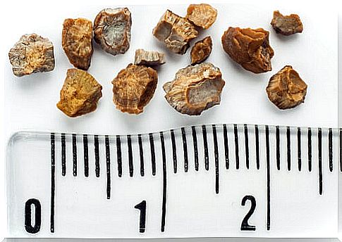 How to remove kidney stones