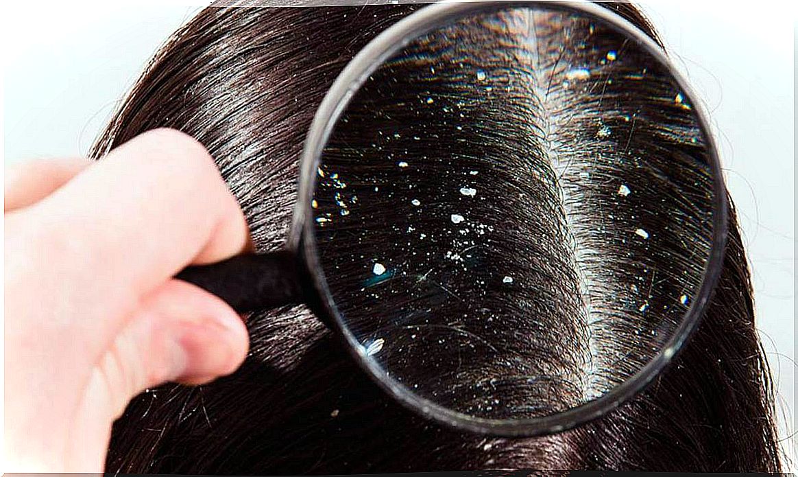 Dandruff scalp