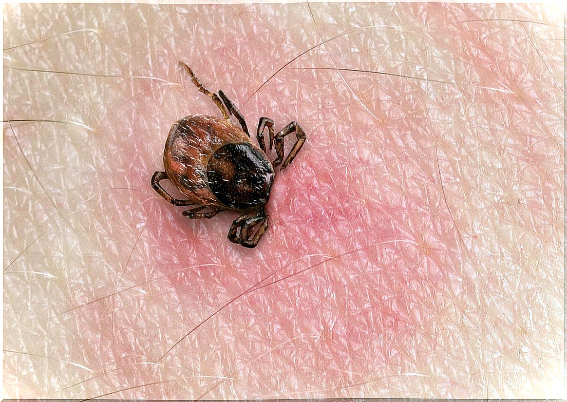 Alpha gal tick syndrome.