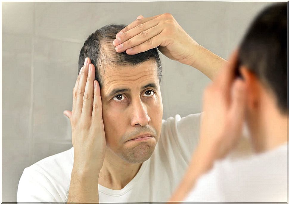 Man with androgenic alopecia