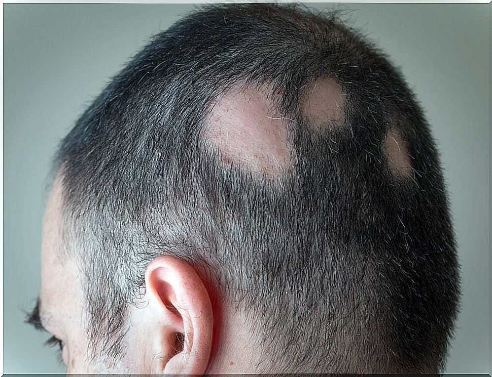 alopecia