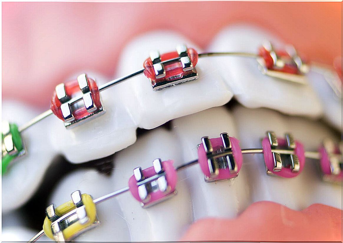 Orthodontics to treat dental malocclusions.