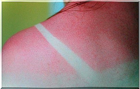 How to treat sunburned skin?