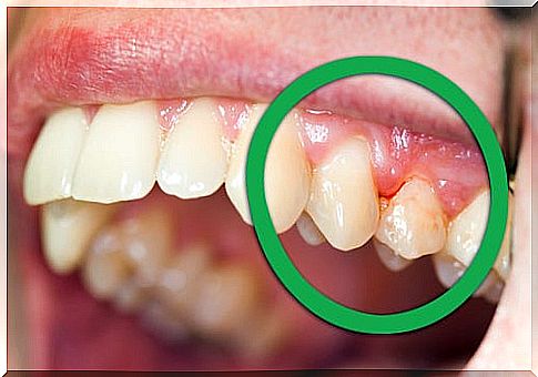 Natural remedies for bleeding gums or loose dentures