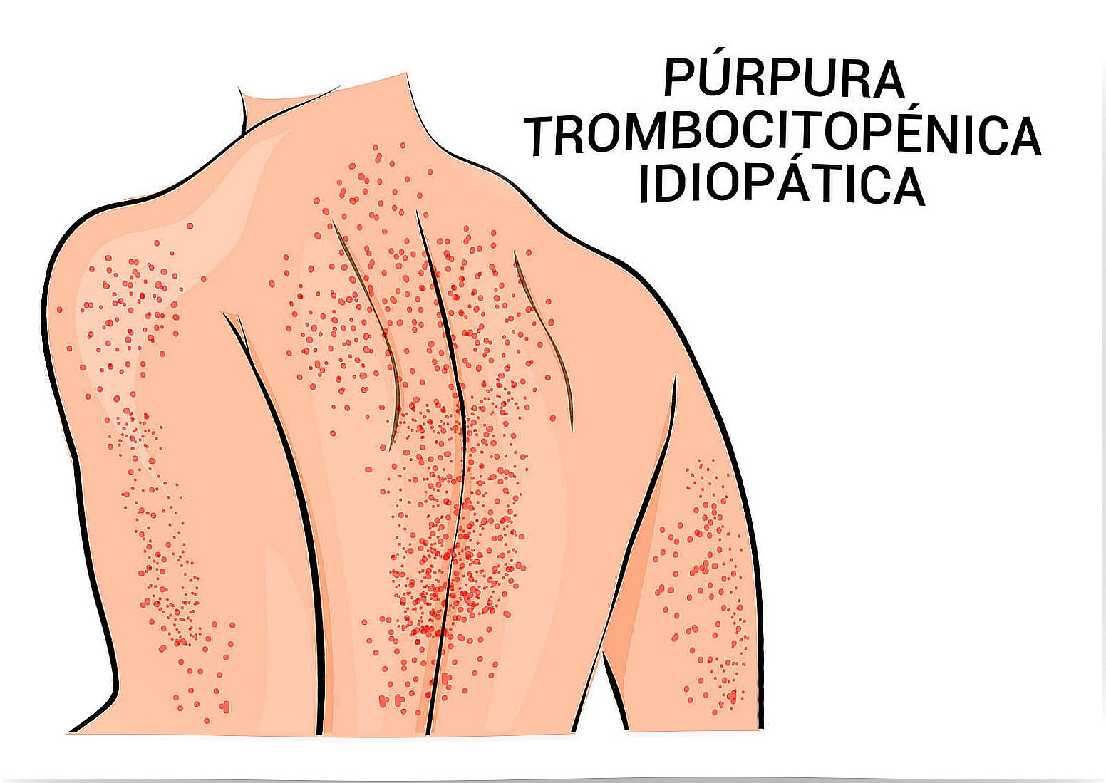 Purpura: symptoms and how it should be treated