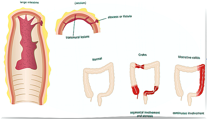 Pathology of Crohn's disease