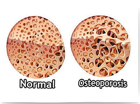 Osteoporosis