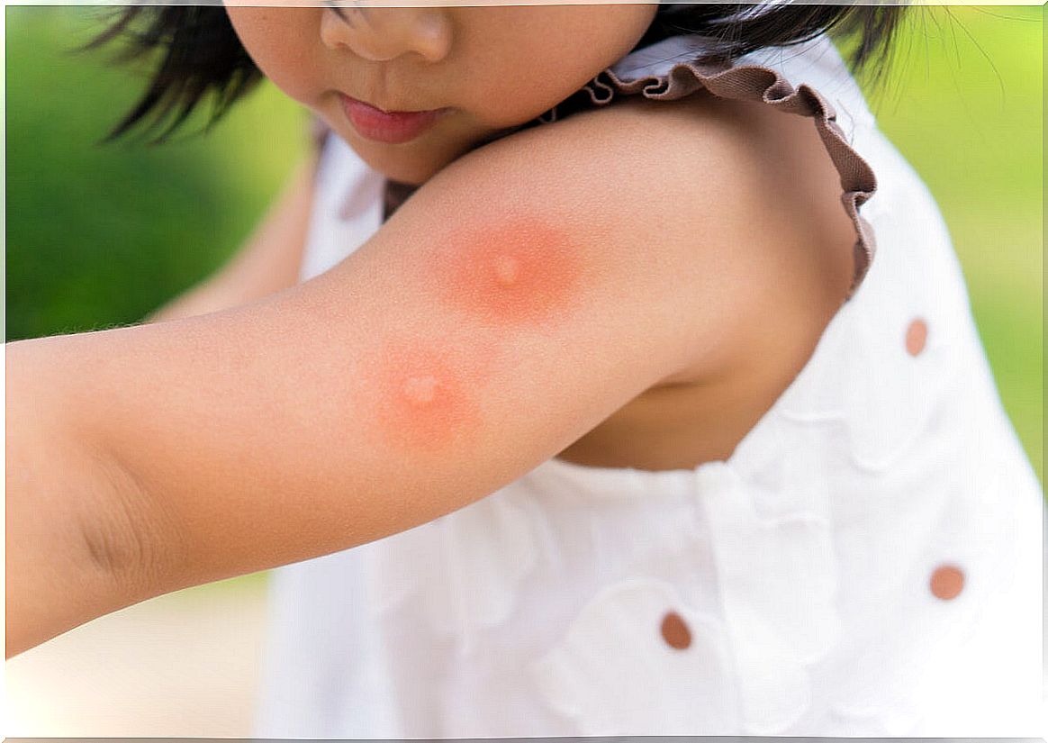 Girl with mosquito bites.